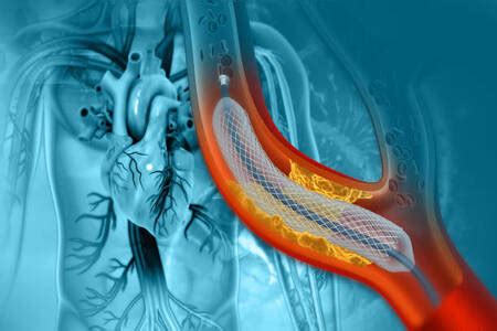 angioplasty surgery philippines|Angioplasty in Philippines .